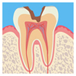 虫歯の中期