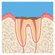 虫歯の末期
